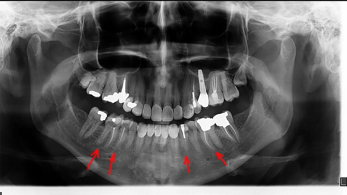 هزینه عصب کشی مجدد دندان-دندانپزشکی دکتر بنیانیان