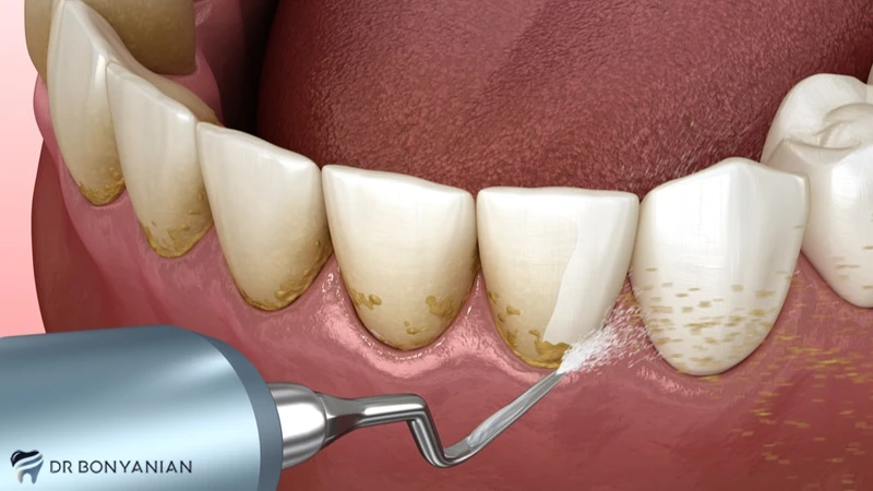 جرم گیری دندان ها از اولویت بندی خدمات دندان پزشکی