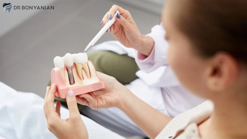 نقش دندانپزشک در ایمپلنت دندان به روش all on 4