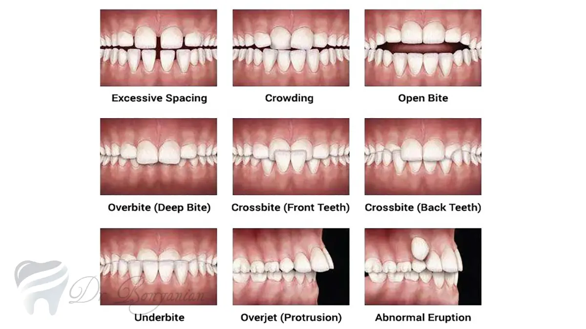 انواع ناهنجاری های دهان و دندان در ارتودنسی​