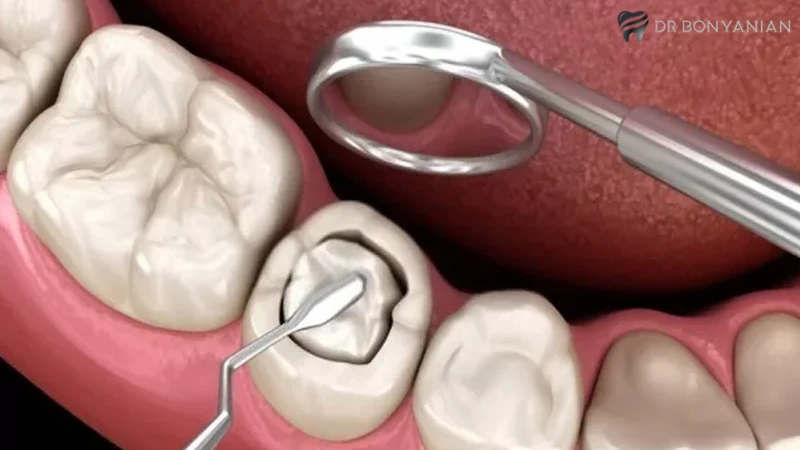 کامپوزیت دندان در دندانپزشکی