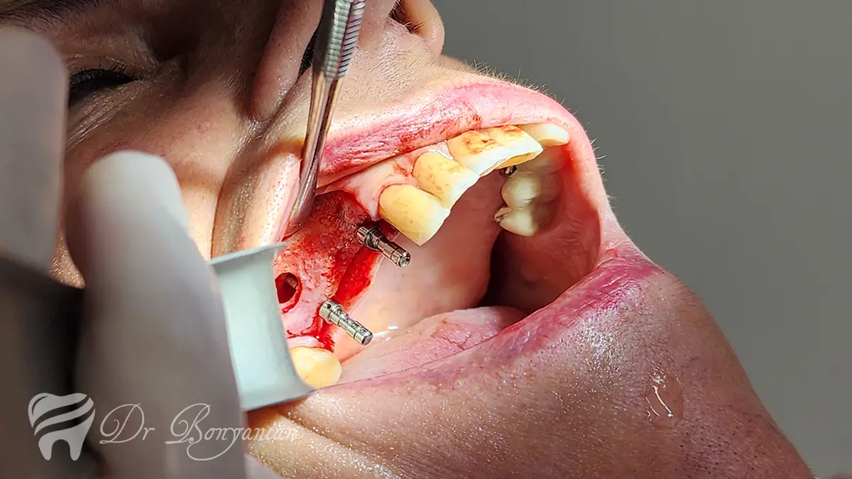 چرا ایمپلنت دندان-دندانپزشکی دکتر بنیانیان