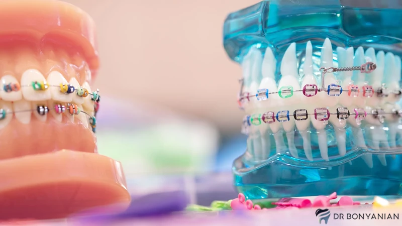 مراقبت های روزانه از ارتودنسی دندان