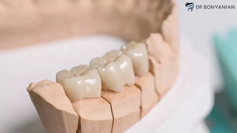 روش‌های مراقبت از روکش دندان