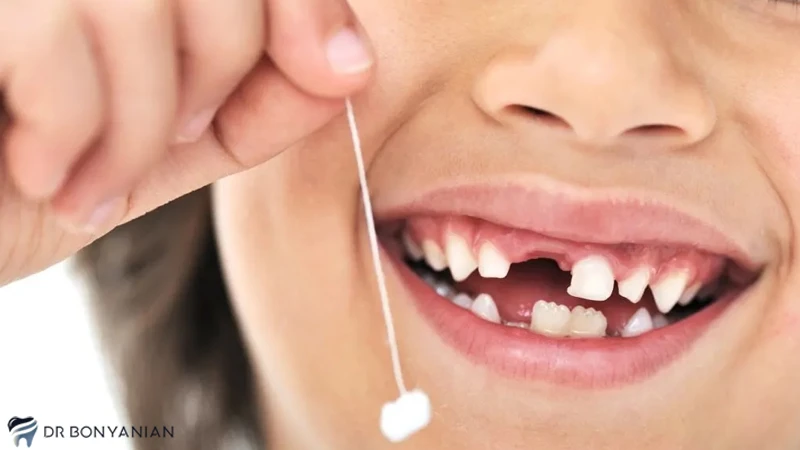 عصب کشی دندان‌های شیری کودکان