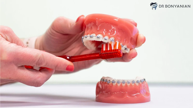 نحوه مراقبت از ارتودنسی دندان