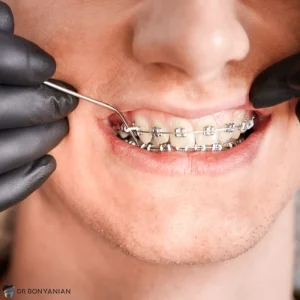 چگونه باید از ارتودنسی دندان های خود مراقبت کنیم؟