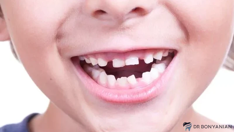 عصب کشی دندان شیری: پالپوتومی و پالپکتومی