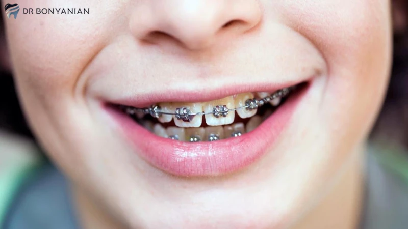 راهکارهای کاهش درد ارتودنسی دندان