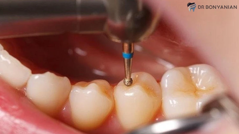 عوارض پرکردن دندان بدون عصب کشی