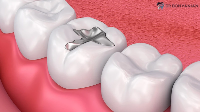 راه‌های کاهش عوارض پر کردن دندان