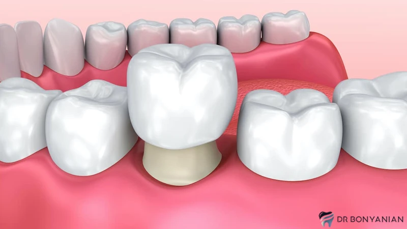 مراقبت های لازم بعد از روکش دندان