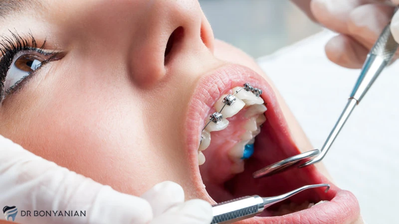دلایل اهمیت مراقبت از ارتودنسی دندان