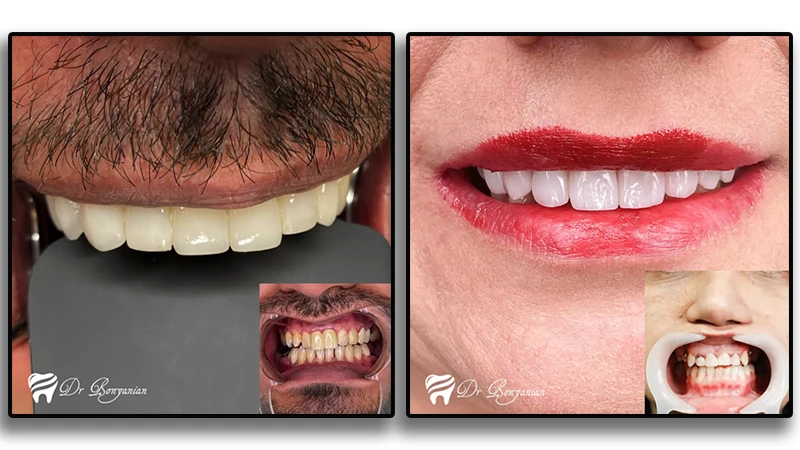 نمونه کار لمینت دندان در کلینیک دندانپزشکی دکتر بنیانیان