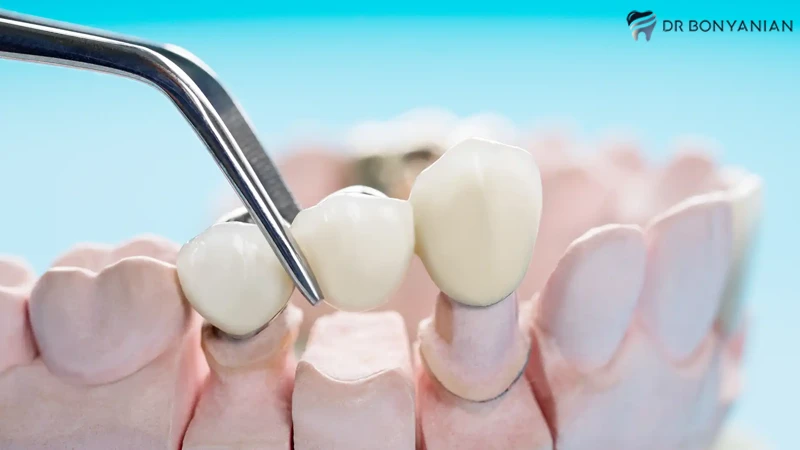 مزایای روکش ایمپلنت دندان