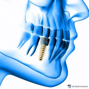 روکش ایمپلنت دندان