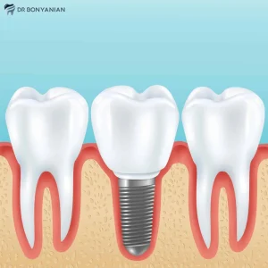 ایمپلنت دندان ایرانی