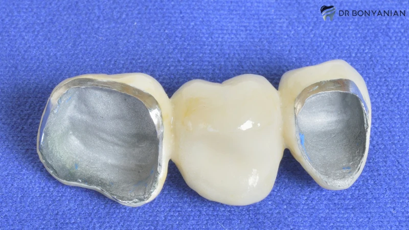 روکش های ایمپلنت دندان PFM (ترکیب سرامیک و فلز)