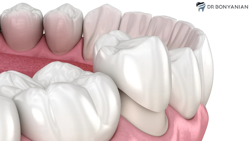 دلایل کاهش عمر روکش دندان