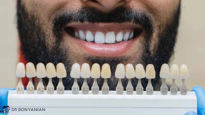 انواع کد رنگ لمینت دندان