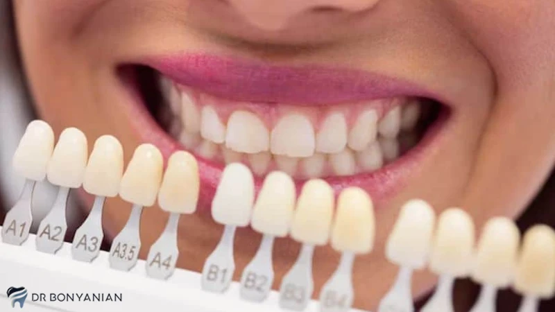 کاتالوگ رنگ لمینت دندان