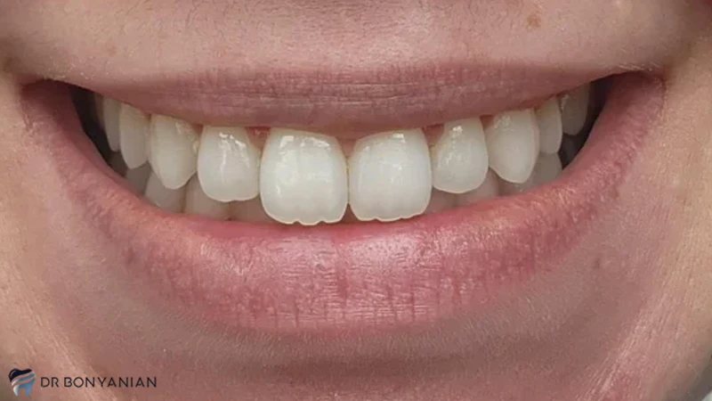 درمان دندان خرگوشی با لمینت