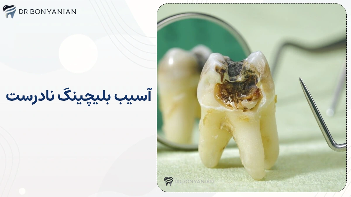 بلیچینگ دندان ارزان در تهران