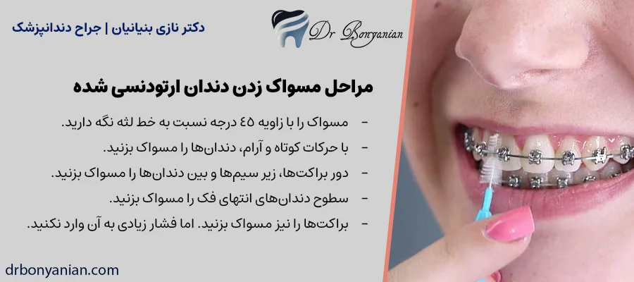 مراحل مسواک زدن دندان ارتودنسی شده