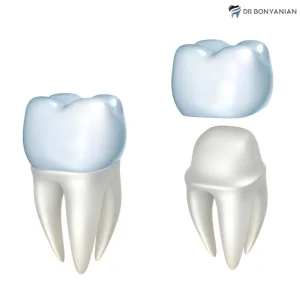 روکش دندان پی اف ام (PFM) چیست؟