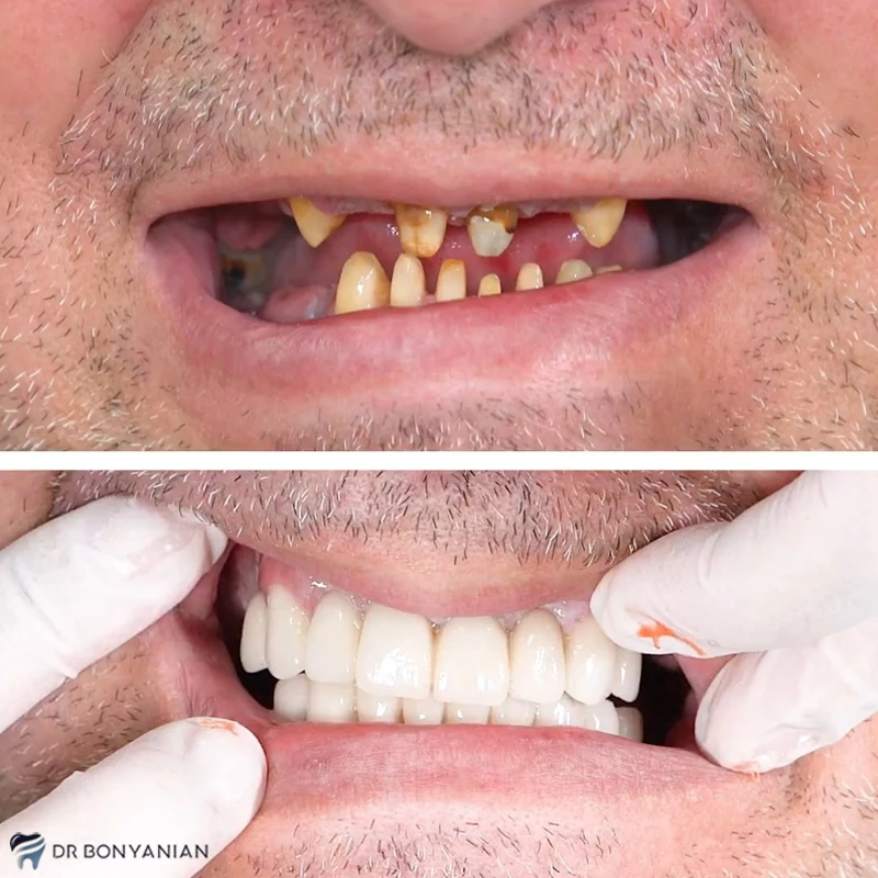 مزایای ایمپلنت دندان در کلینیک دندانپزشکی دکتر بنیانیان