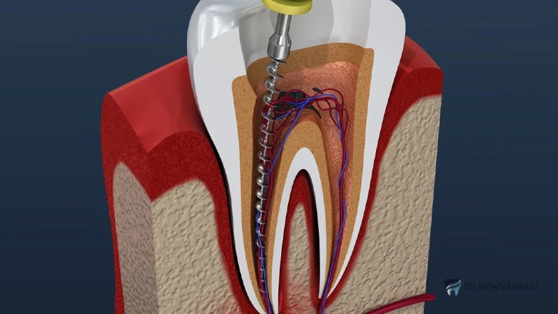 Tooth pain after root canal