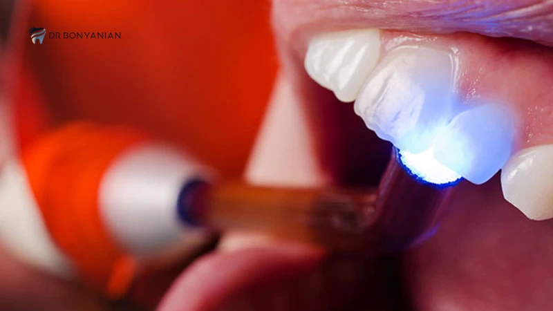 مراقبت از کامپوزیت دندان