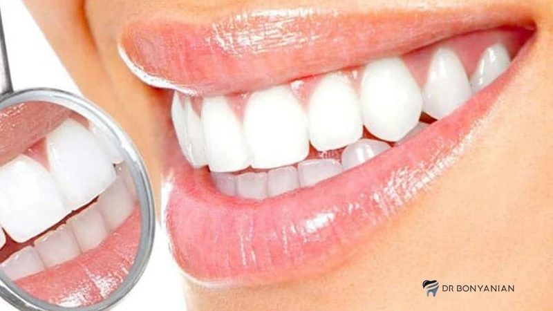 مراقبت بعد از کامپوزیت دندان