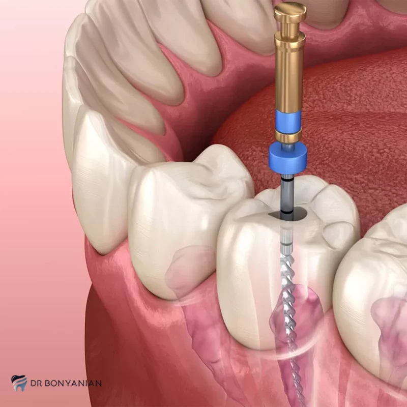دندان عصب کشی شده چقدر عمر میکند؟