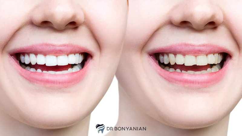 پالیش کامپوزیت دندان چیست