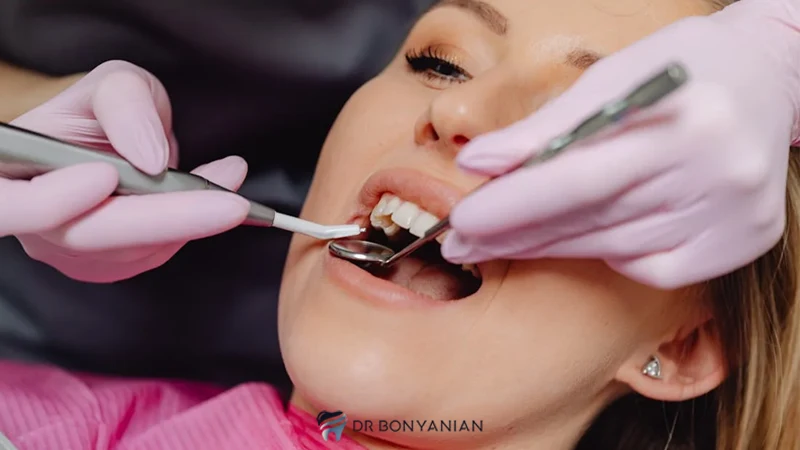 پولیش دندان بعد از کامپوزیت