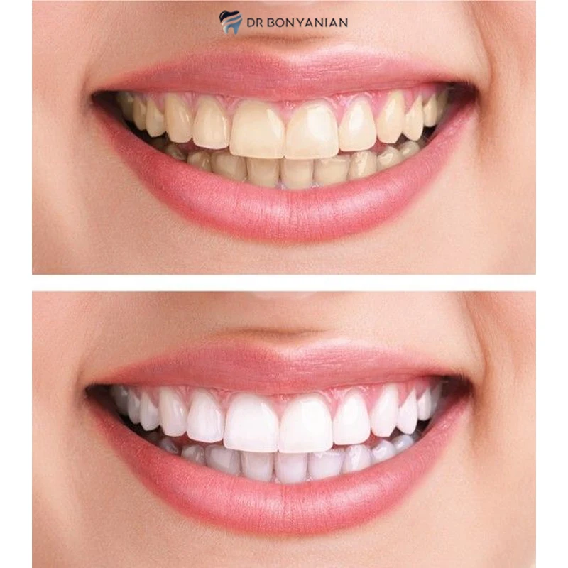 Dental composite polishing
