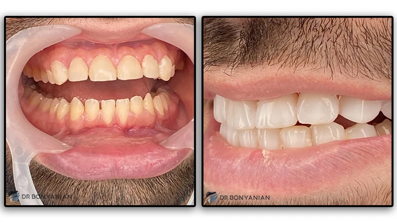 عوامل موثر بر تعیین ضخامت کامپوزیت دندان