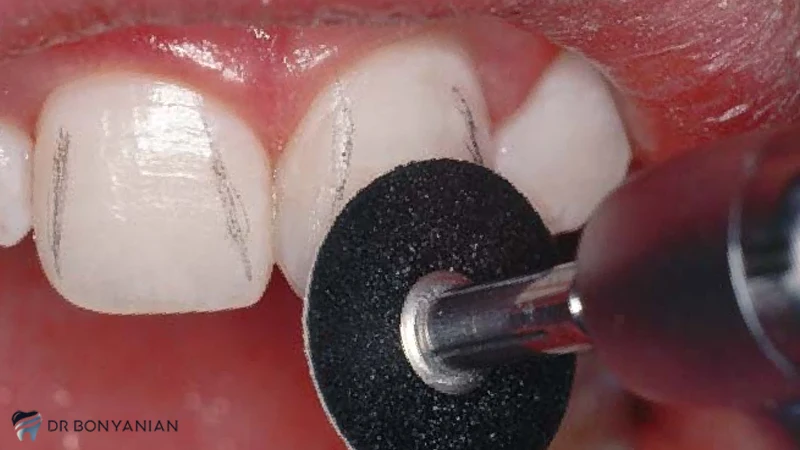 پولیش دندان کامپوزیت شده در خانه