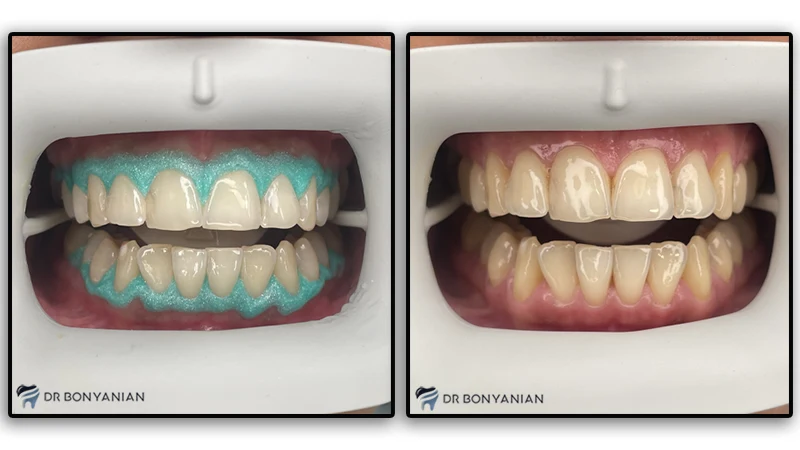 مراقبتهای بعد از بلیچینگ دندان 