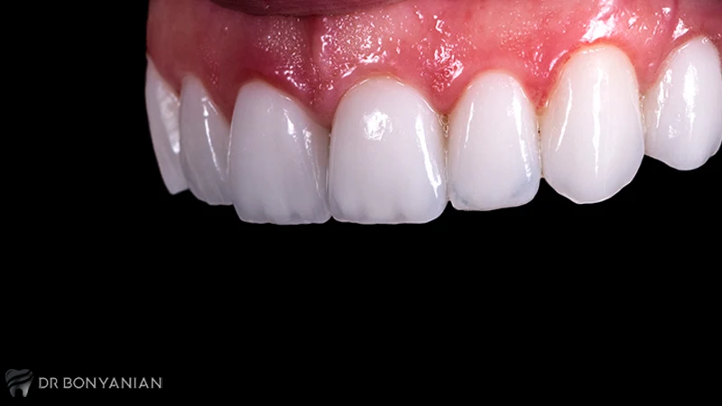 کامپوزیت لب شیشه ای