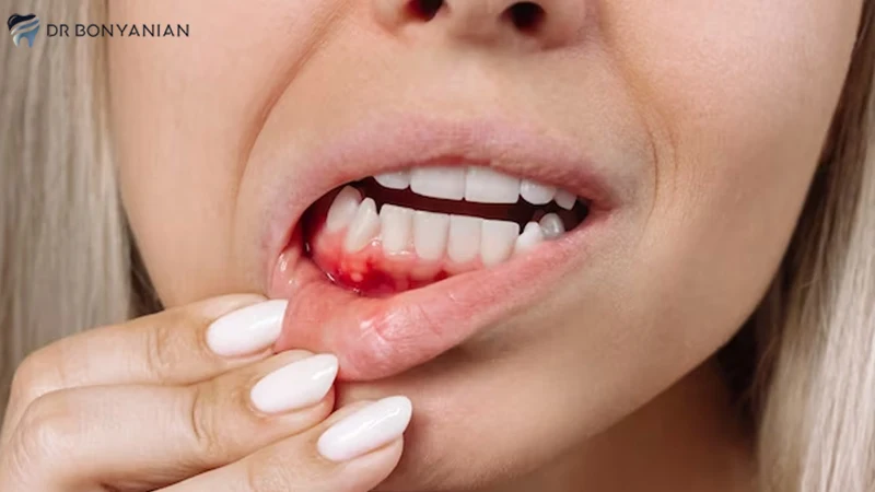 کشیدن ریشه دندان عفونی