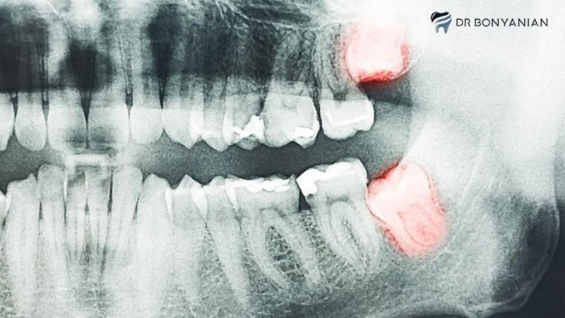 کشیدن دندان عفونتی