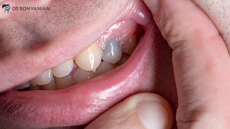 کشیدن دندانی که کیست دارد