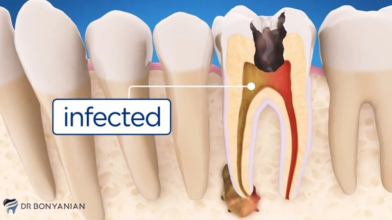 علائم کشیدن دندان