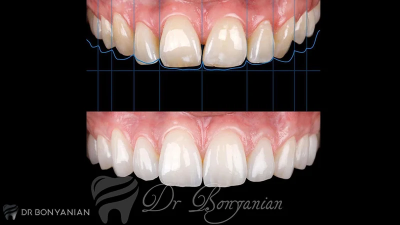 نمونه عکس کامپوزیت لبه شیشه ای