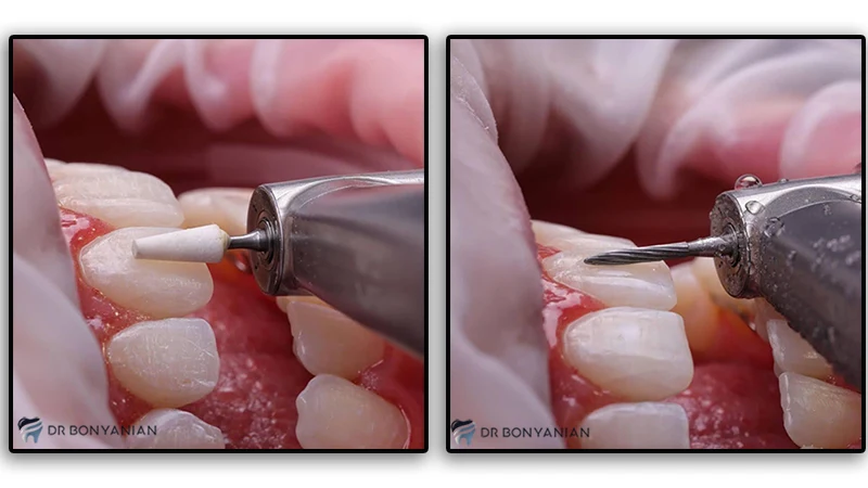 نمونه کار کامپوزیت لبه شیشه ای