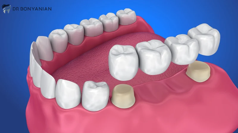 کاربردهای FRC در دندانپزشکی