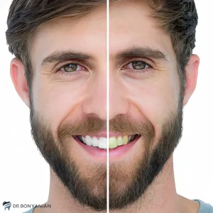 بلیچینگ چقدر دندان ها را سفید میکند؟