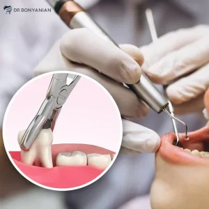 در چه شرایطی یا چه زمانی، دندان باید کشیده شود؟